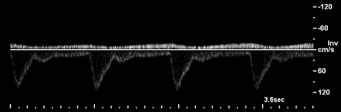 Dopplerův efekt změna frekvence je determinována rychlostí intenzita signálu je determinována množstvím pohybujících se elementů (např.