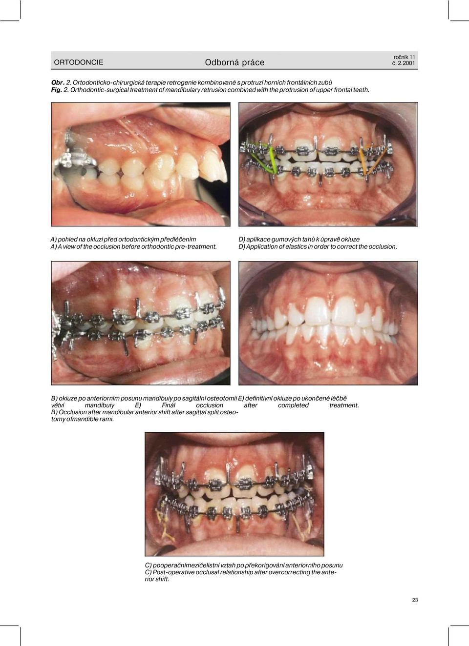 D) aplikace gumových tahů k úpravě okiuze D) Application of elastics in order to correct the occlusion.