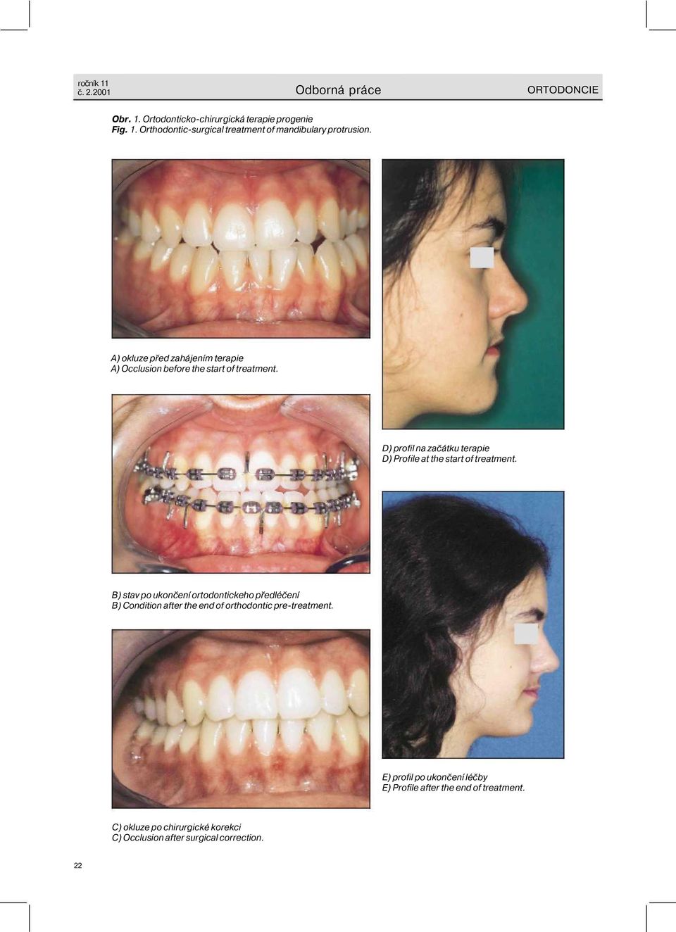 D) profil na začátku terapie D) Profile at the start of treatment.
