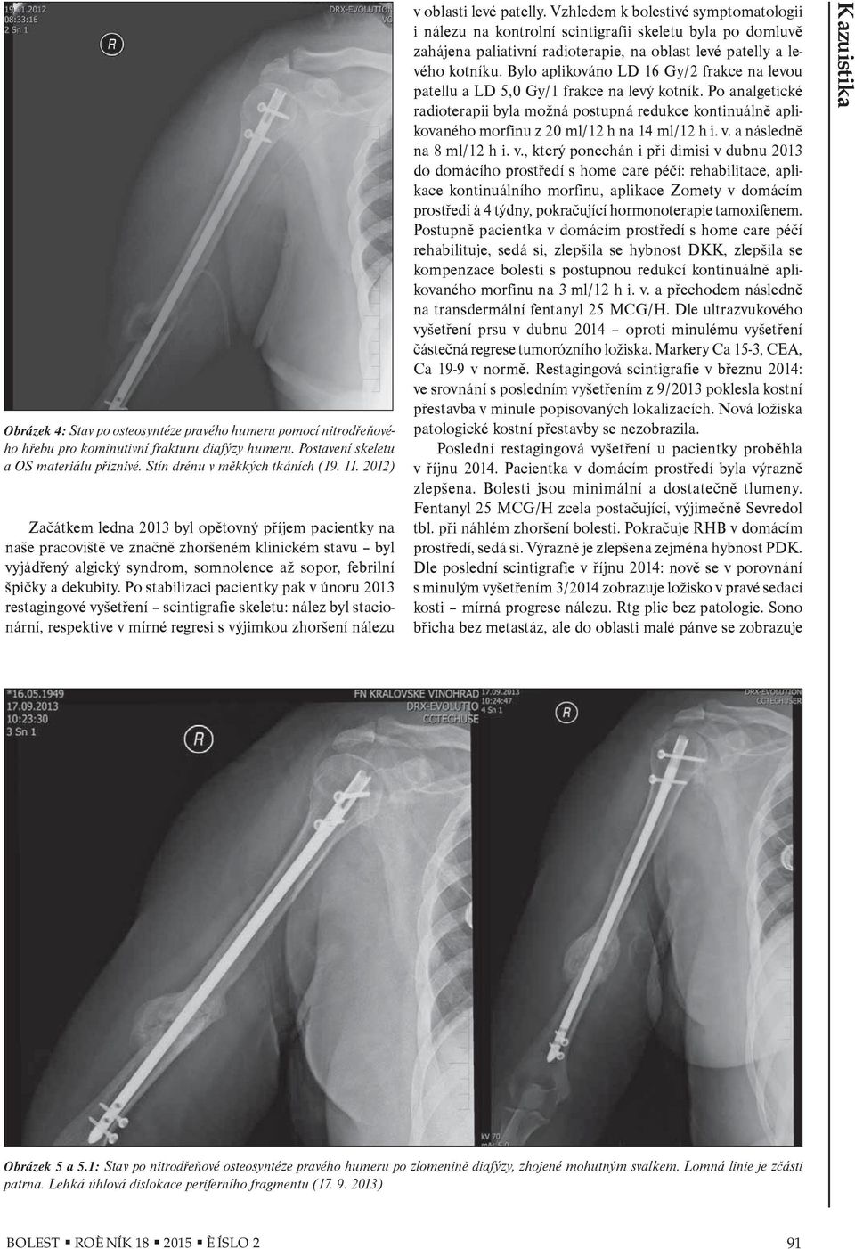 Po stabilizaci pacientky pak v únoru 2013 restagingové vyšetøení scintigrafie skeletu: nález byl stacionární, respektive v mírné regresi s výjimkou zhoršení nálezu v oblasti levé patelly.