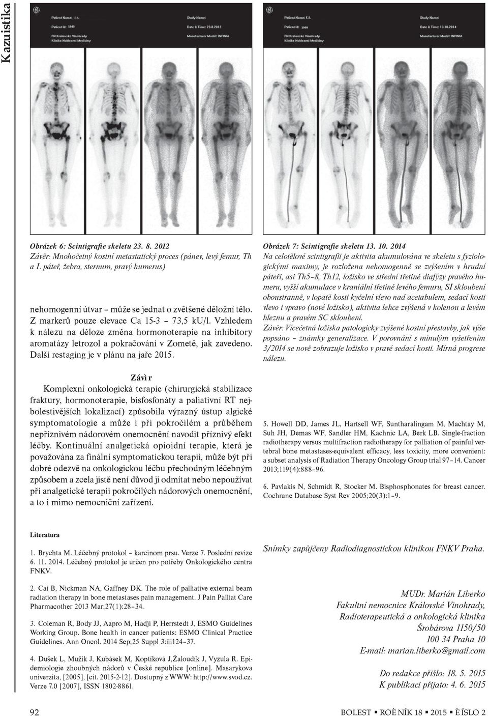 Z markerù pouze elevace Ca 15-3 73,5 ku/l. Vzhledem k nálezu na dìloze zmìna hormonoterapie na inhibitory aromatázy letrozol a pokraèování v Zometì, jak zavedeno.