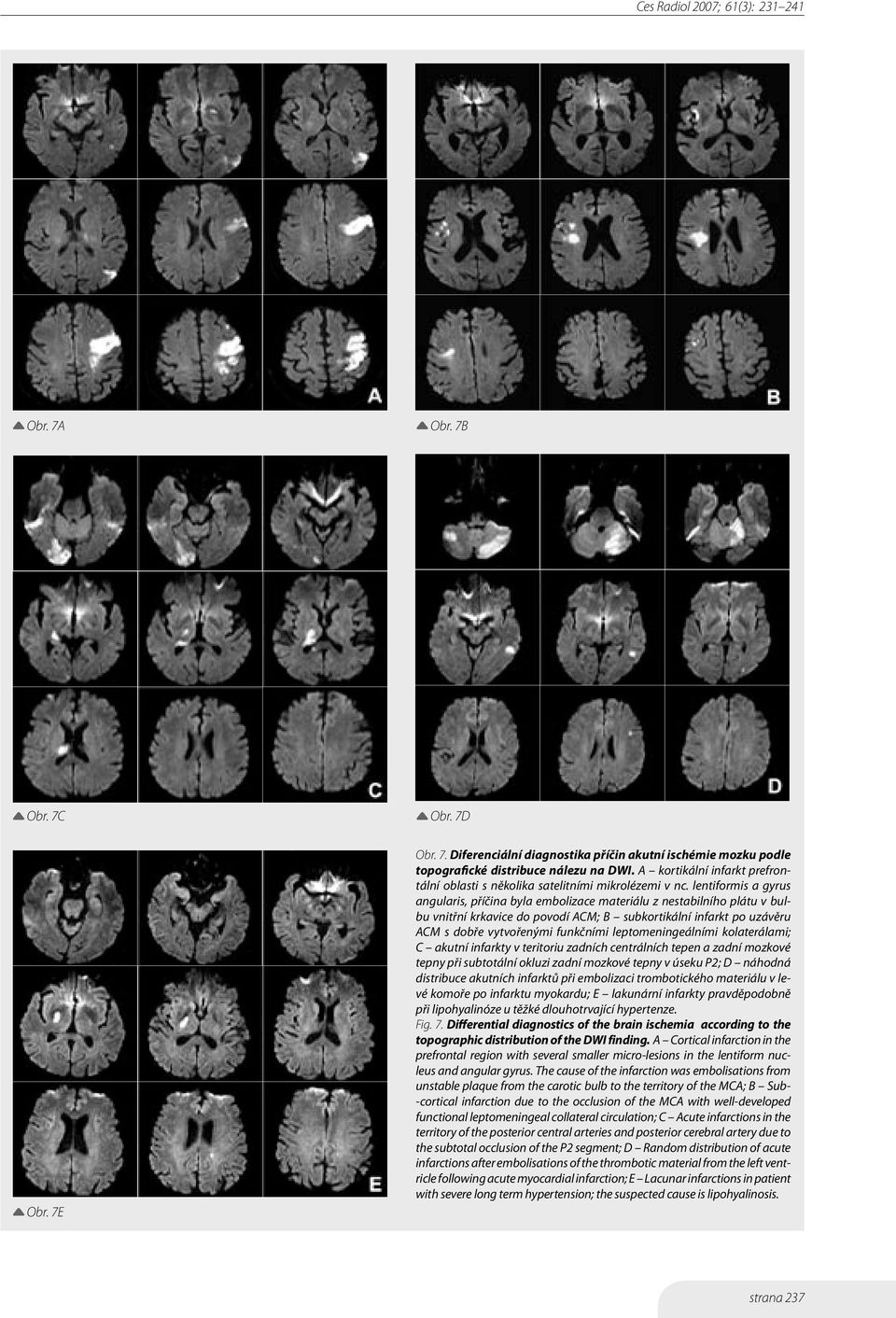 lentiformis a gyrus angularis, příčina byla embolizace materiálu z nestabilního plátu v bulbu vnitřní krkavice do povodí ACM; B subkortikální infarkt po uzávěru ACM s dobře vytvořenými funkčními