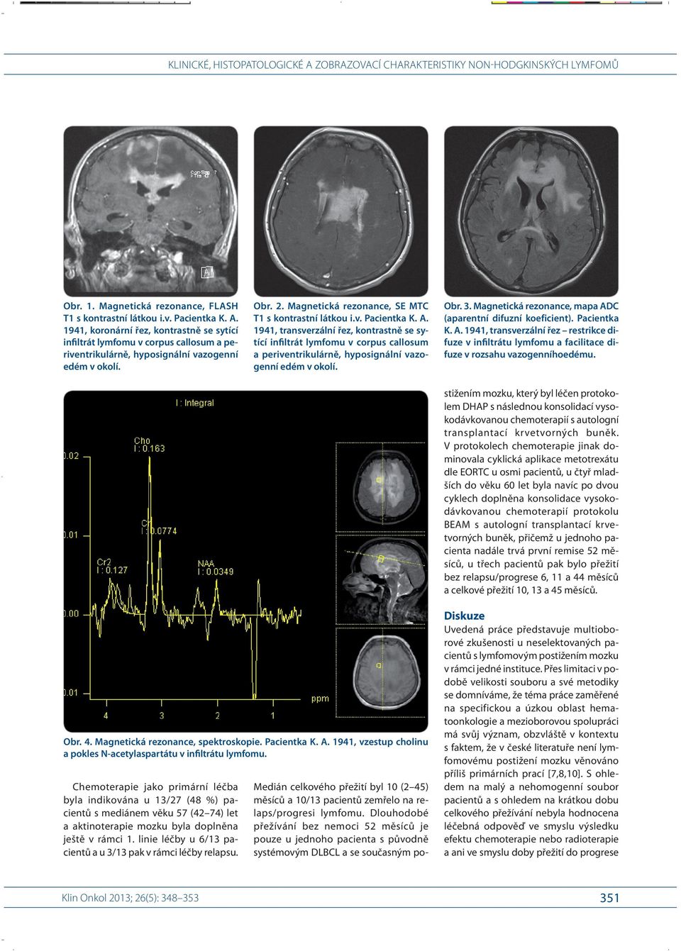 1941, transverzální řez, kontrastně se sytící infiltrát lymfomu v corpus callosum a periventrikulárně, hyposignální vazogenní edém v okolí. Obr. 3.