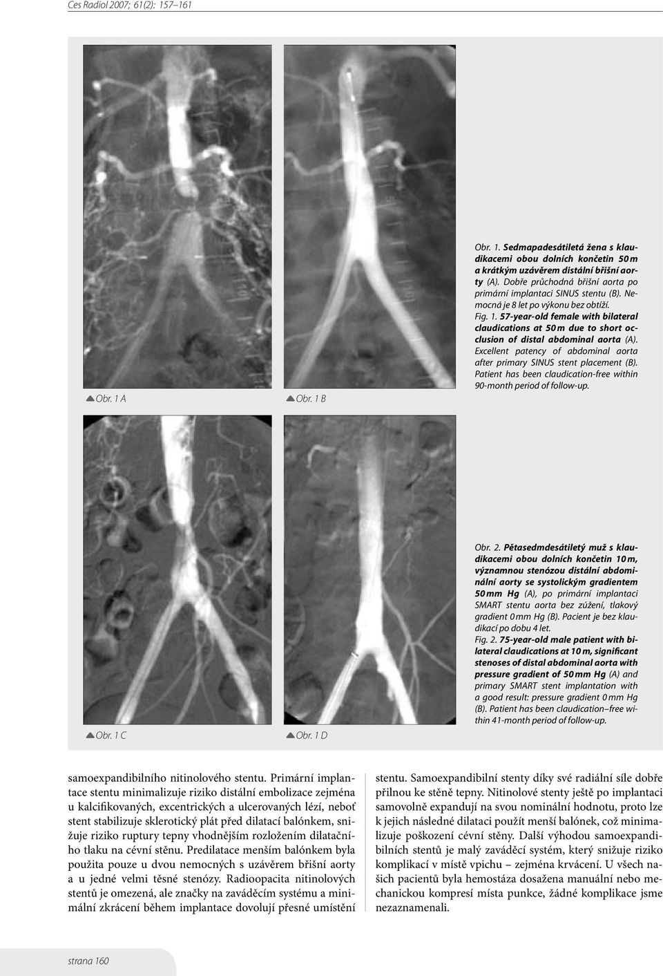 57-year-old female with bilateral claudications at 50 m due to short occlusion of distal abdominal aorta (A). Excellent patency of abdominal aorta after primary SINUS stent placement (B).