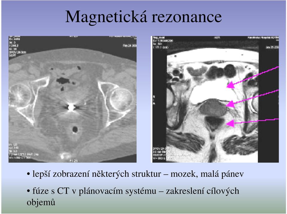 mozek, malá pánev fúze s CT v