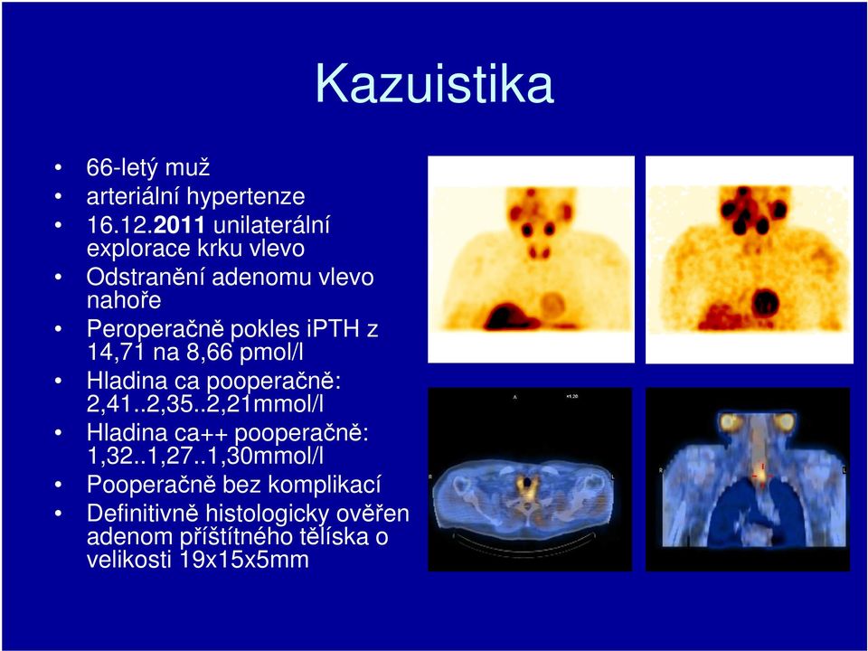 ipth z 14,71 na 8,66 pmol/l Hladina ca pooperačně: 2,41..2,35.