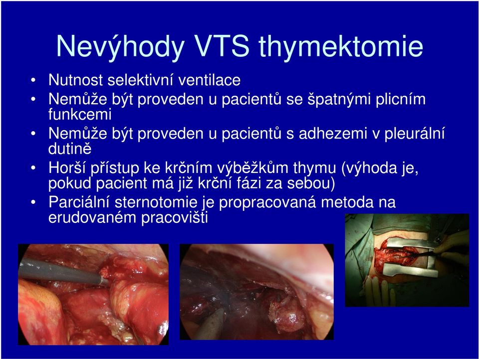 dutině Horší přístup ke krčním výběžkům thymu (výhoda je, pokud pacient má již krční