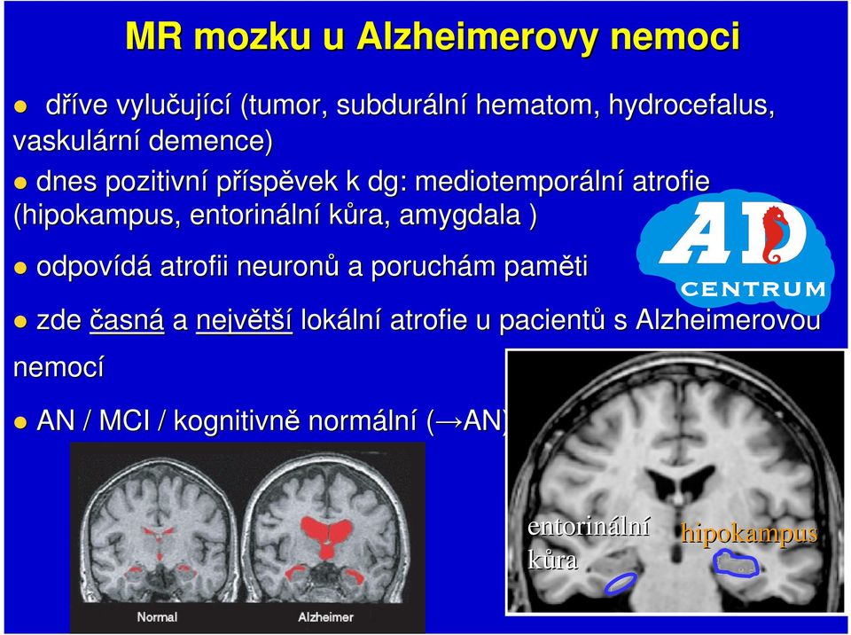 amygdala ) odpovídá atrofii neuronů a poruchám m paměti zde časná a největší lokáln lní atrofie u pacientů
