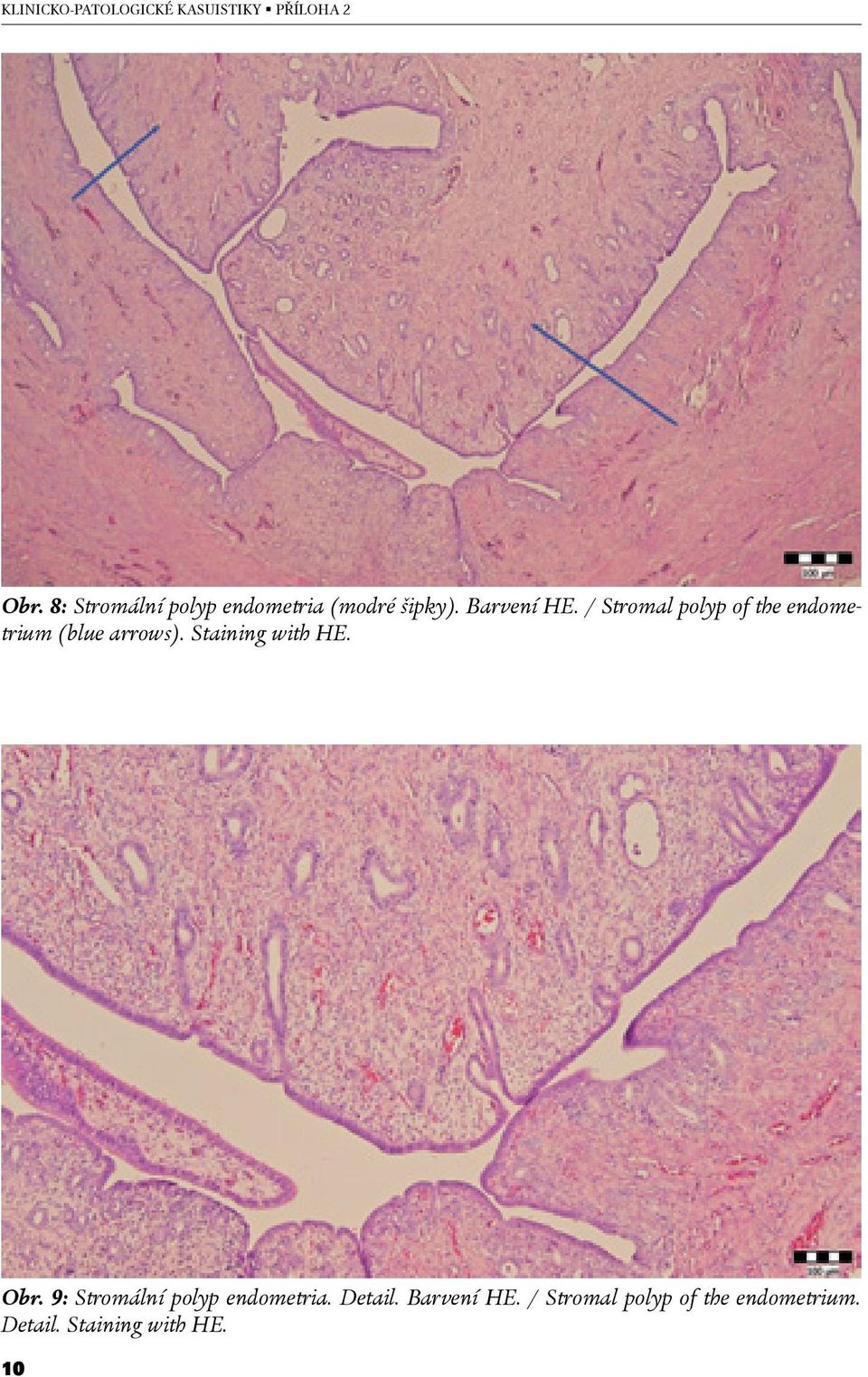 Staining with HE. Obr. 9: Stromální polyp endometria. Detail.