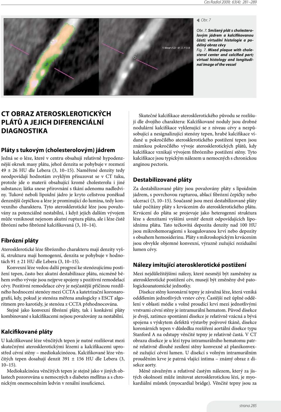 Smíšený plát s cholesterolovým jádrem a kalcifikovanou částí; virtuální histologie a podélný obraz cévy Fig. 7.