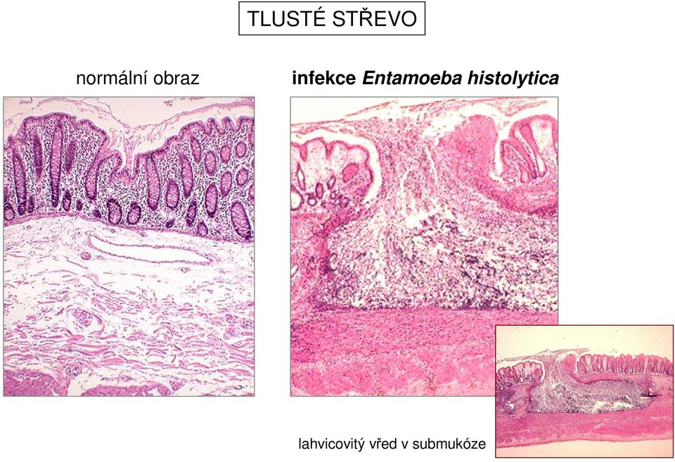 infekce Entamoeba