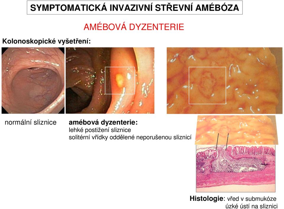 dyzenterie: lehké postižení sliznice solitérní vřídky