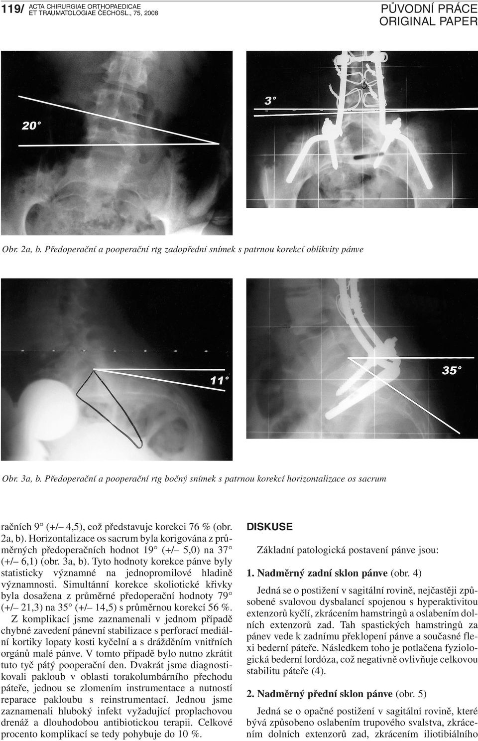 Horizontalizace os sacrum byla korigována z průměrných předoperačních hodnot 19 (+/ 5,0) na 37 (+/ 6,1) (obr. 3a, b).
