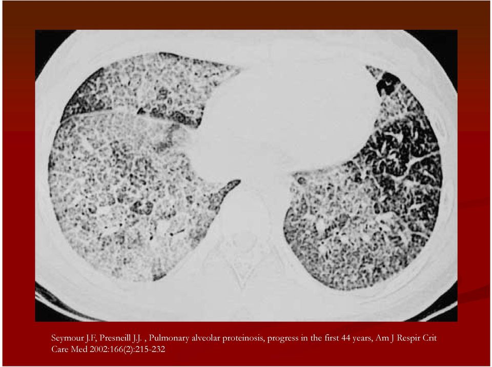 J., Pulmonary alveolar