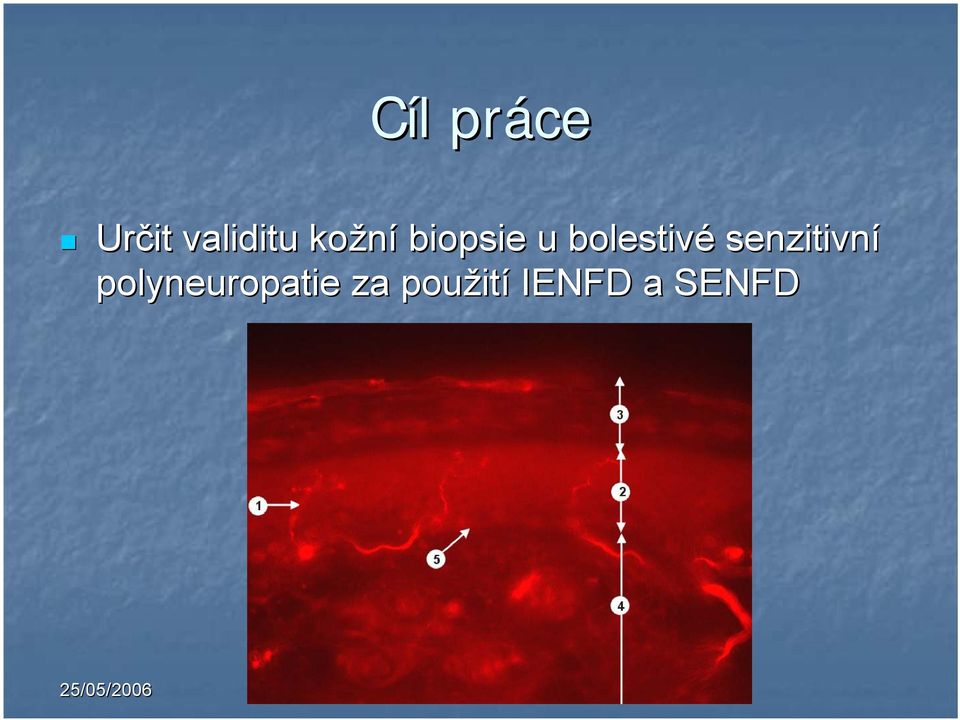 senzitivní polyneuropatie