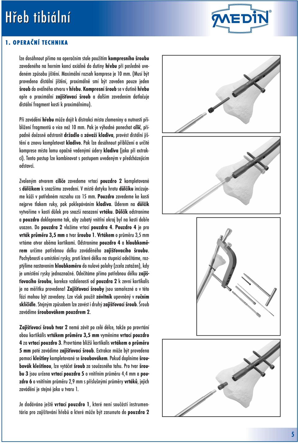 Kompresní šroub se v dutině hřebu opře o proximální zajišťovací šroub a dalším zavedením dotlačuje distální fragment kosti k proximálnímu).