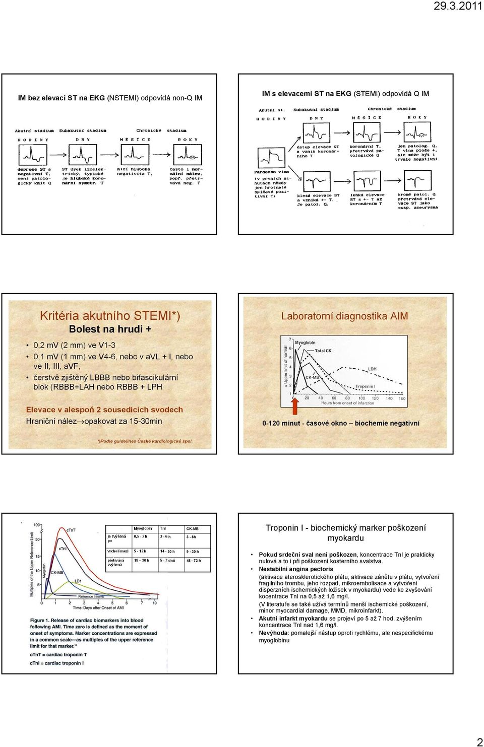 Nestabilní angina pectoris (aktivace aterosklerotického plátu, aktivace zánětu v plátu, vytvoření fragilního trombu, jeho rozpad, mikroembolisace a vytvoření disperzních ischemických ložisek v