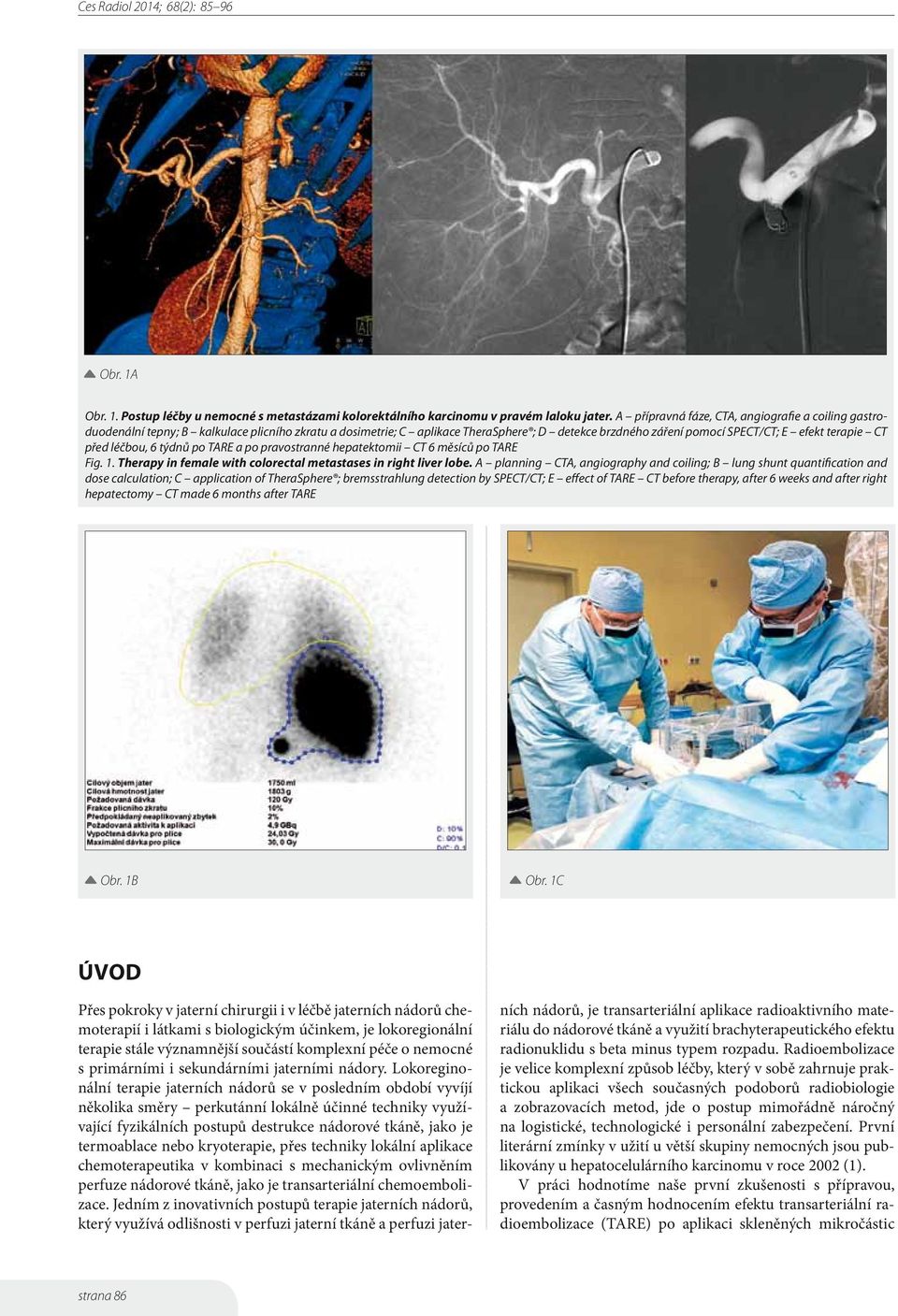 před léčbou, 6 týdnů po TARE a po pravostranné hepatektomii CT 6 měsíců po TARE Fig. 1. Therapy in female with colorectal metastases in right liver lobe.