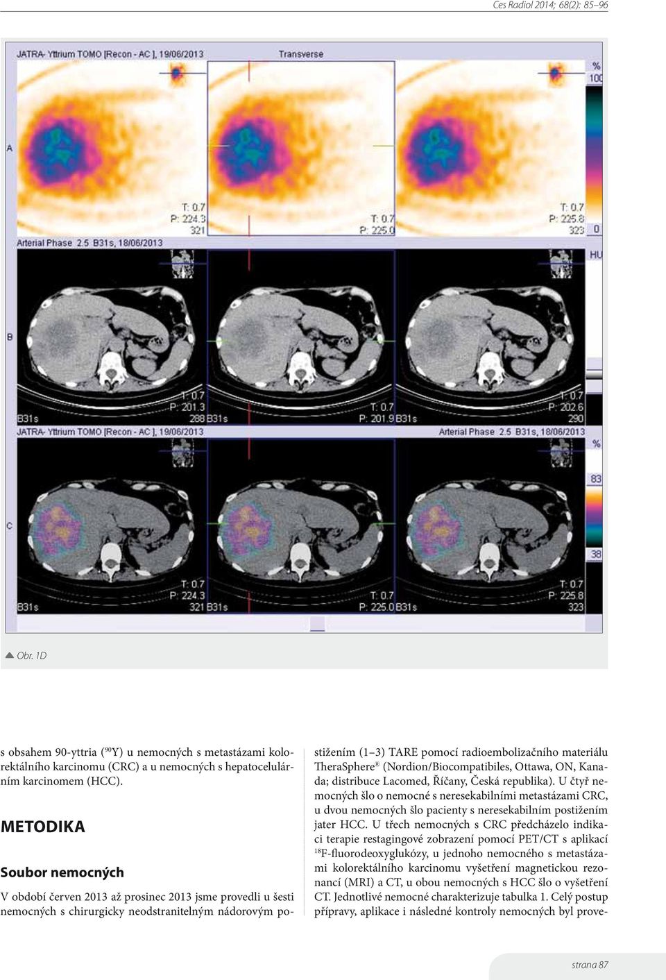 U třech nemocných s CRC předcházelo indikaci terapie restagingové zobrazení pomocí PET/CT s aplikací 18 F-fluorodeoxyglukózy, u jednoho nemocného s metastázami kolorektálního karcinomu vyšetření