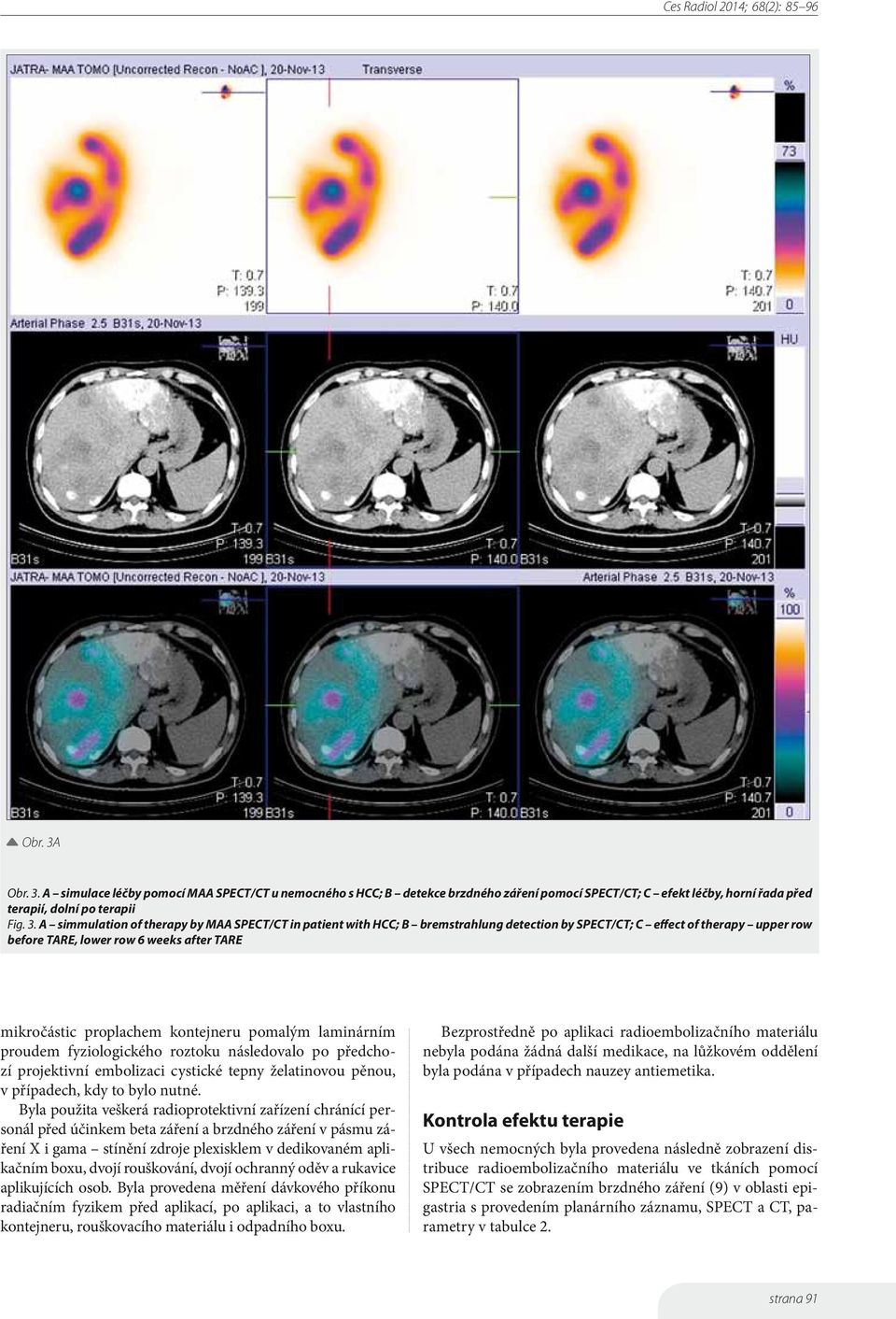 A simulace léčby pomocí MAA SPECT/CT u nemocného s HCC; B detekce brzdného záření pomocí SPECT/CT; C efekt léčby, horní řada před terapií, dolní po terapii Fig. 3.
