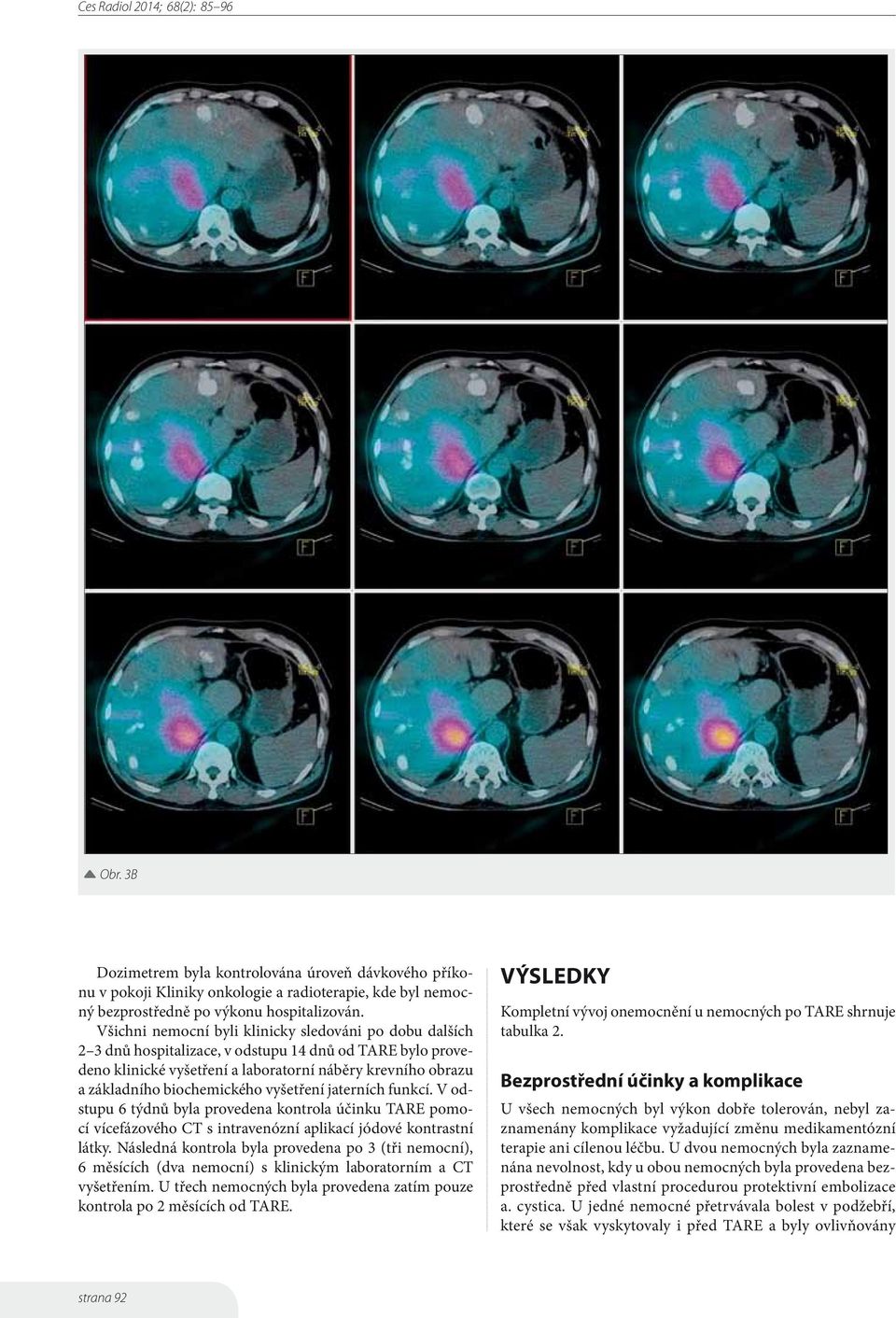 biochemického vyšetření jaterních funkcí. V odstupu 6 týdnů byla provedena kontrola účinku TARE pomocí vícefázového CT s intravenózní aplikací jódové kontrastní látky.