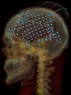 K diagnostice mtb lze užít PET ( pozitronová emisní tomografie) s fluorodeoxyglukózou ( FDG-PET).