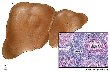 Chronické selhání jater: úbytek metabolických funkcí portální hypertenze: venostáza ve střevě (porucha motility, translokace), hypersplenismus,