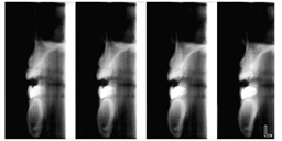 tomografické snímkování pro implantologické plánování Nárust používání kostních integrovaných implantátů vytvořilo širší požadavky na rentgenové techniky pro předoperační a pooperační hodnocení
