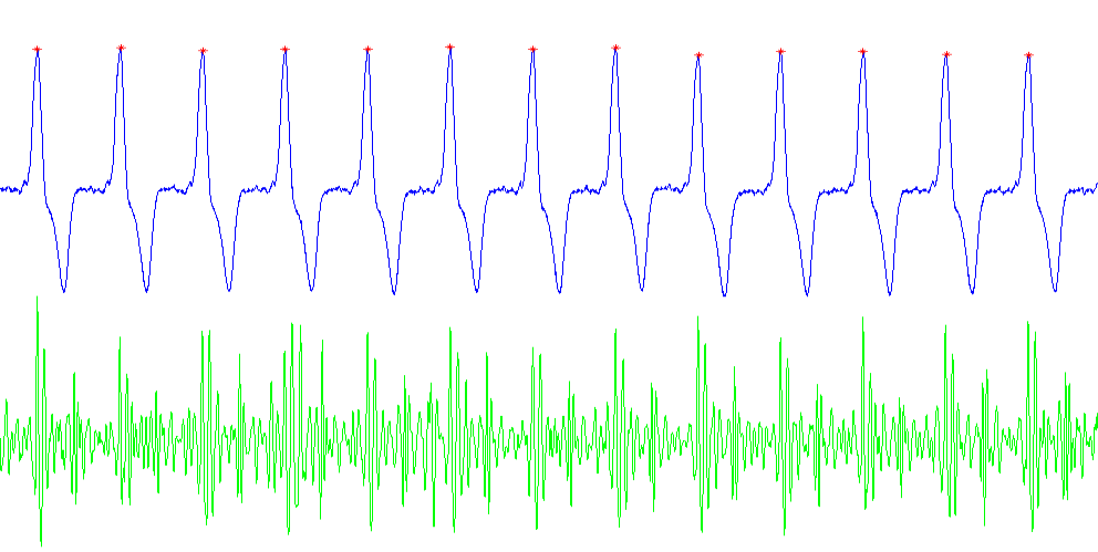 Příklad postupu nalezení s1: ECG + Odpovídající zvukový