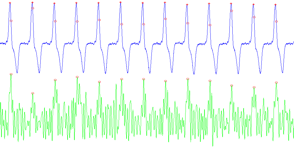 Filtrace dolní propustí: ECG Zvuk Nalezení s1: ECG