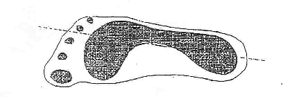 střední úzké části spojnice tuto linii překrývá na vnitřní straně, osoba má ploché chodidlo. (Purgarič, 1994) Obr.
