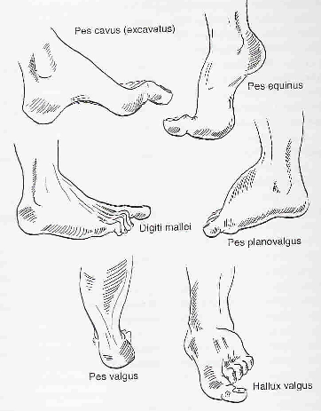 i druhotně, při poškození musculi tibialis a následném výpadku lýtkového svalstva, při porušení Achillovy šlachy. (Kubát, 1985) Obr.