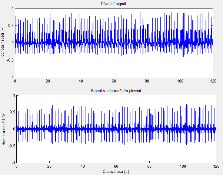 elektroda kůže (asi do 0.8 Hz), dýcháním (asi do 0.5 Hz) a pomalými pohyby klienta (asi do 2 Hz).[7] Filtrace je v programu Matlab provedena filtrem typu horní propust s mezní frekvencí 5 Hz.