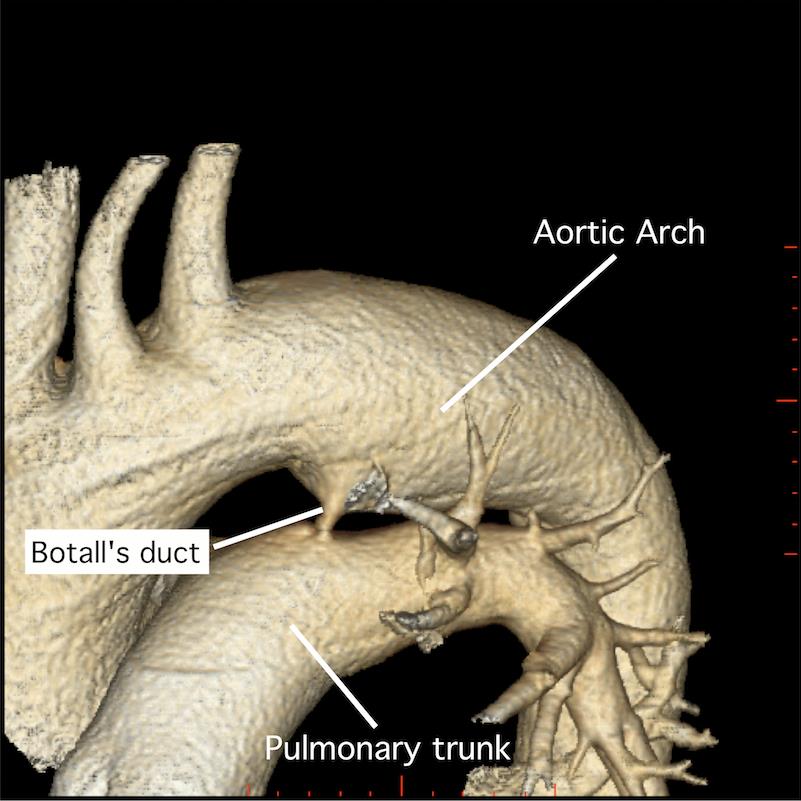 Ductus arteriosus Botalli Tepenná (Botallova) dučej http://images.radiopaedia.