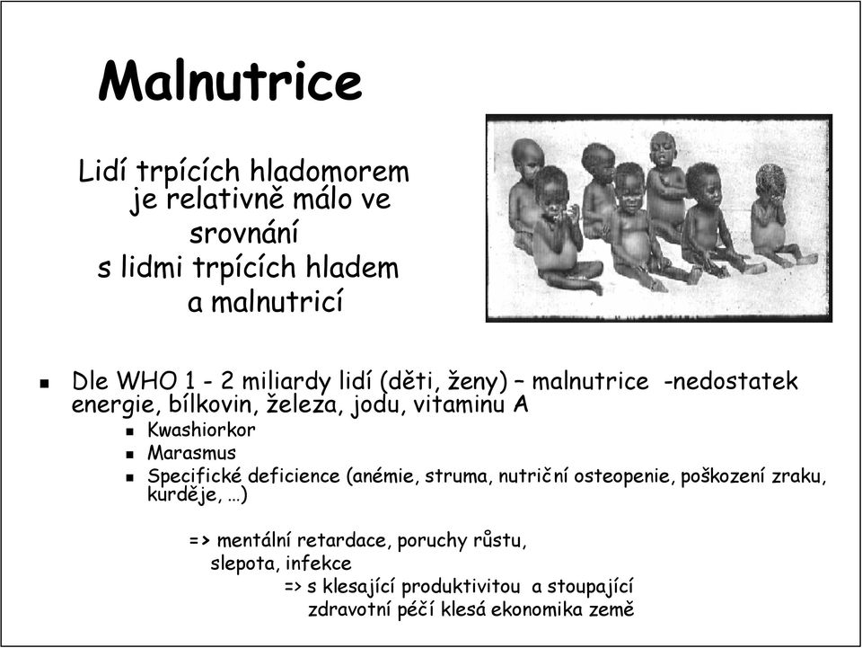 Marasmus Specifické deficience (anémie, struma, nutriční osteopenie,, poškozen kození zraku, kurděje, ) => mentáln
