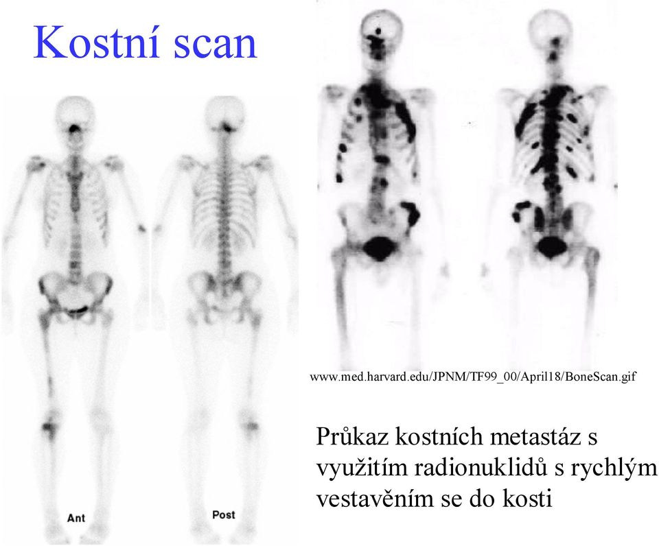 gif Průkaz kostních metastáz s