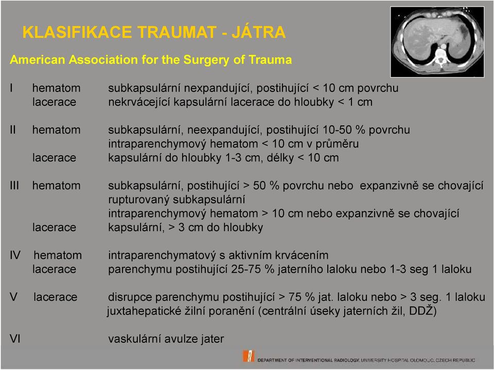 postihující > 50 % povrchu nebo expanzivně se chovající rupturovaný subkapsulární intraparenchymový hematom > 10 cm nebo expanzivně se chovající lacerace kapsulární, > 3 cm do hloubky IV hematom