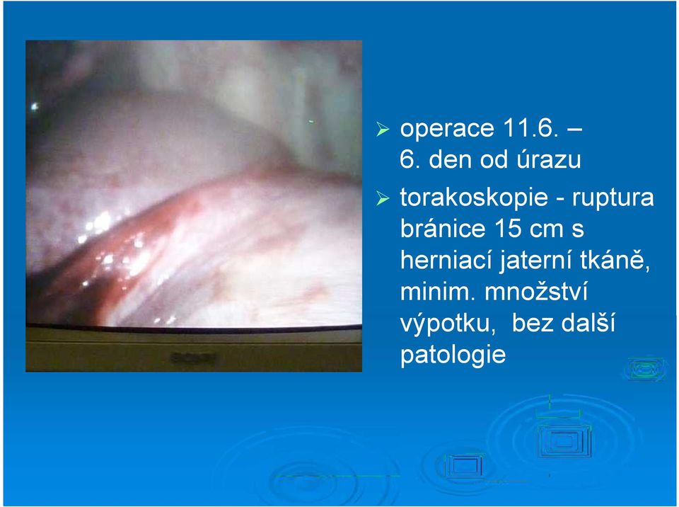 ruptura bránice 15 cm s herniací
