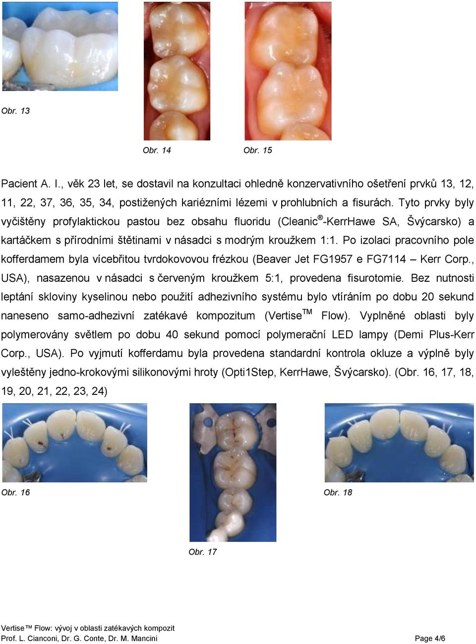 Tyto prvky byly vyčištěny profylaktickou pastou bez obsahu fluoridu (Cleanic -KerrHawe SA, Švýcarsko) a kartáčkem s přírodními štětinami v násadci s modrým kroužkem 1:1.