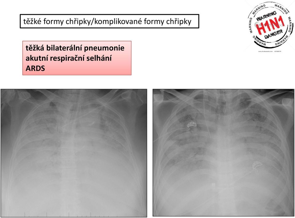 chřipky těžká bilaterální