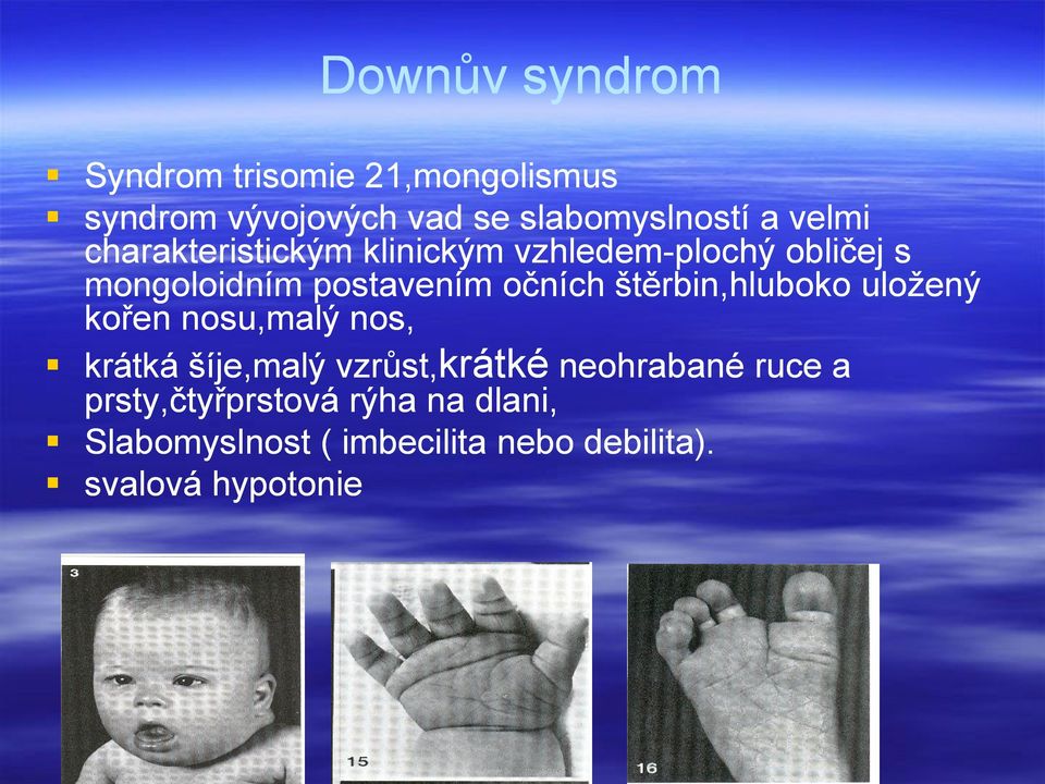 štěrbin,hluboko uložený kořen nosu,malý nos, krátká šíje,malý vzrůst,krátké neohrabané ruce