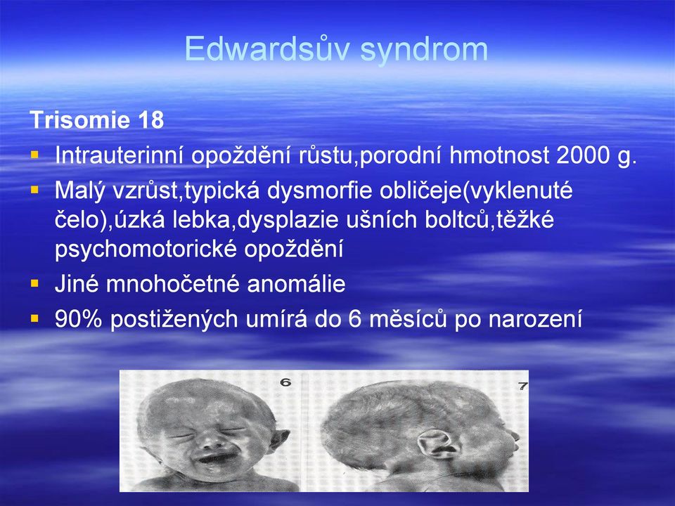 Malý vzrůst,typická dysmorfie obličeje(vyklenuté čelo),úzká