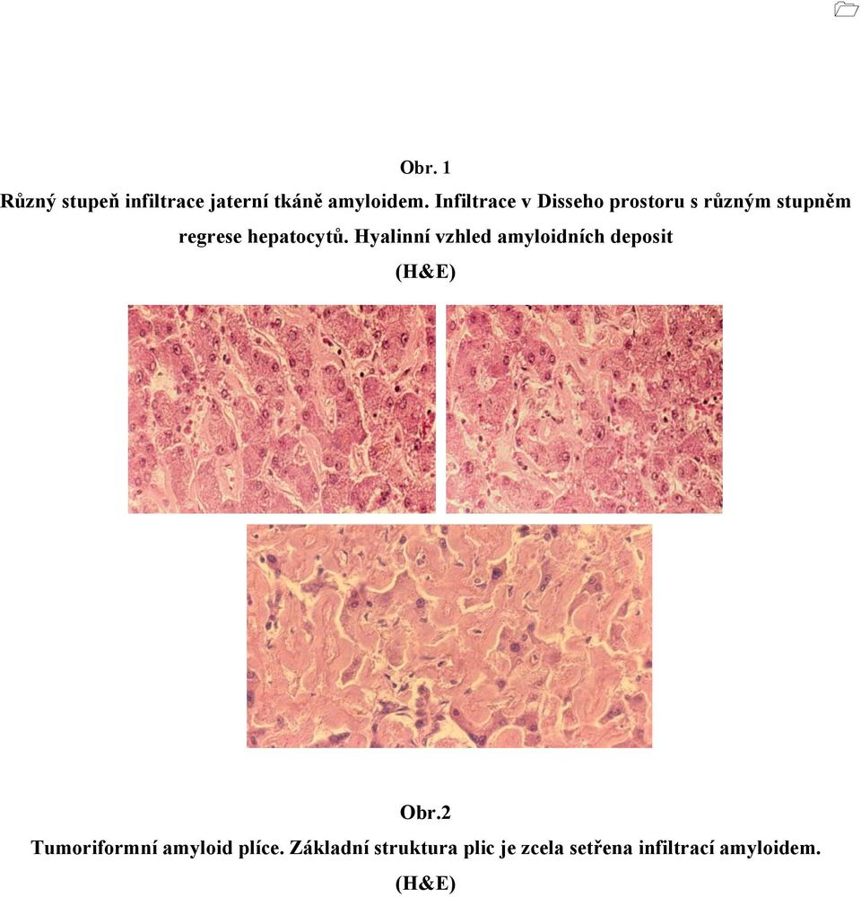 Hyalinní vzhled amyloidních deposit (H&E) Obr.