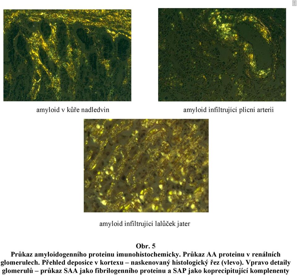 Průkaz AA proteinu v renálních glomerulech.