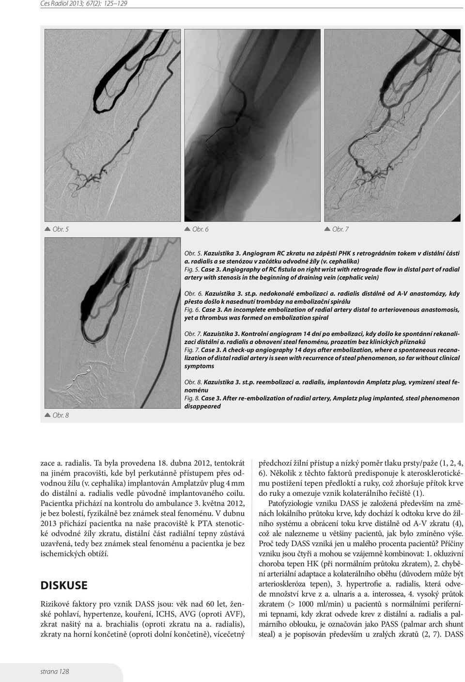 radialis distálně od A-V anastomózy, kdy přesto došlo k nasednutí trombózy na embolizační spirálu Fig. 6. Case 3.