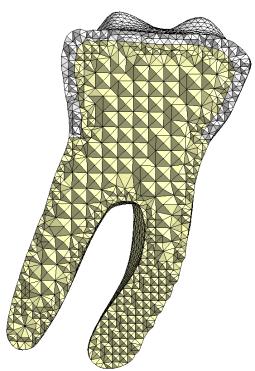 Sklovina Sklovina Metoda Hex Dominant Dentin Kortikální kost Spongiózní kost Tetrahedrons - Path Indenpendent Obr. 6 MKP model zubu.