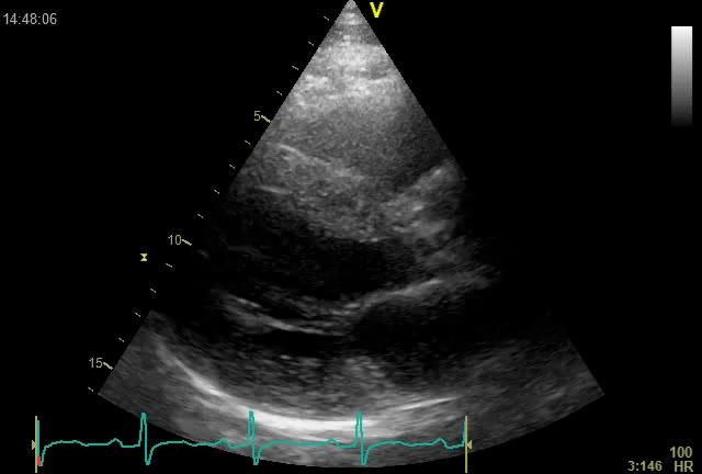 HYPERTROFIE LK míra hypertrofie se liší, její přesný prognostický význam není znám někdy dochází k asymetrické hypertrofii septum/zs, která regreduje po