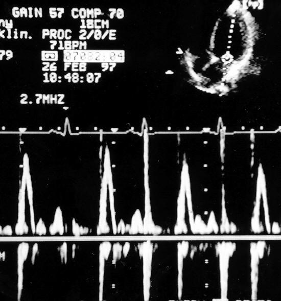 Dopplerovská echokardiografie Dopplerovský záznam