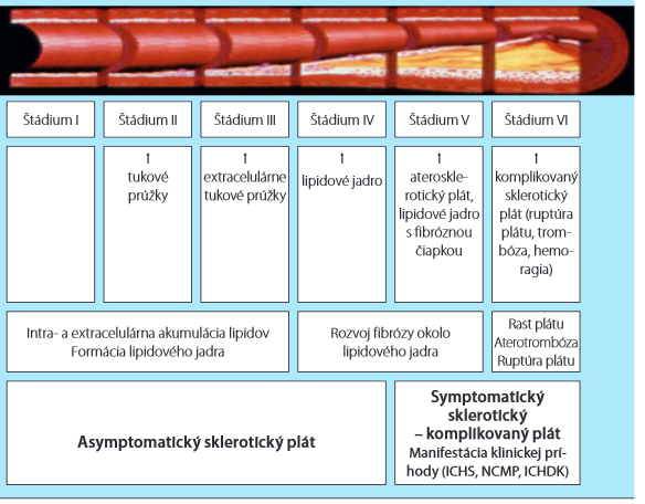 Ateroskleróza Štádium latencie - bez klinických prejavov - aterosklerotické zmeny v cievach (poškodenie vnútornej vrstvy tzv.