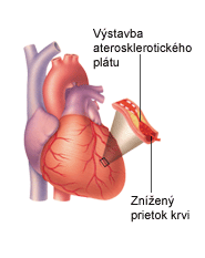 Postihnutie koronárnych artérií Ateroskleróza Dôsledky Ischemická choroba srdca (ICHS) artérie čiastočne prechodné o Bez prejavov (len zmeny EKG) o S prejavmi bolesti z hrudnou kosťou (angina